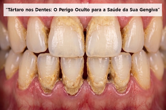 Escova os dentes e o tártaro não sai? A culpa pode não ser sua
