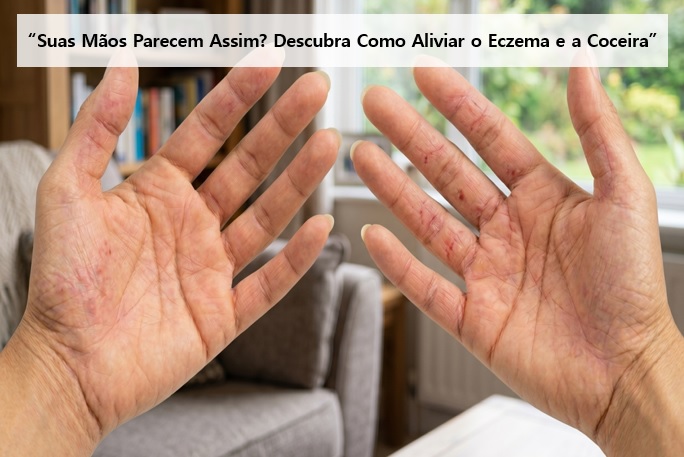 Eczema nas mãos: Achei que era só pele seca e me enganei (Minha experiência)