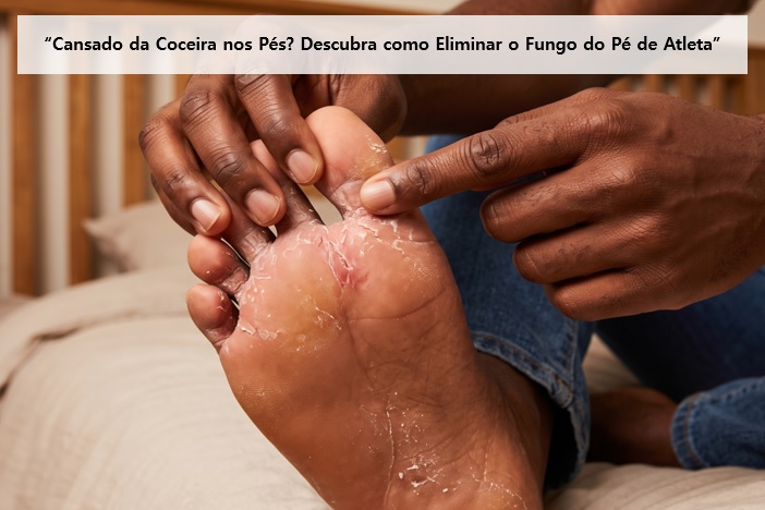 Frieira (Pé de Atleta) é falta de higiene? A verdade que ninguém te conta