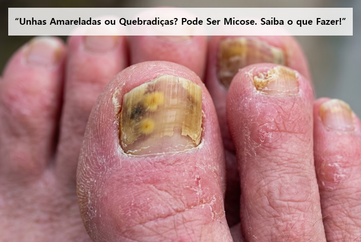 Unha amarelada? A verdade sobre o tratamento da micose de unha (Onicomicose)