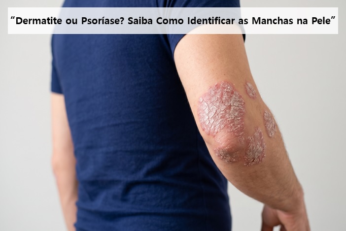 Psoríase não é apenas pele seca: Minha jornada e como controlo a doença